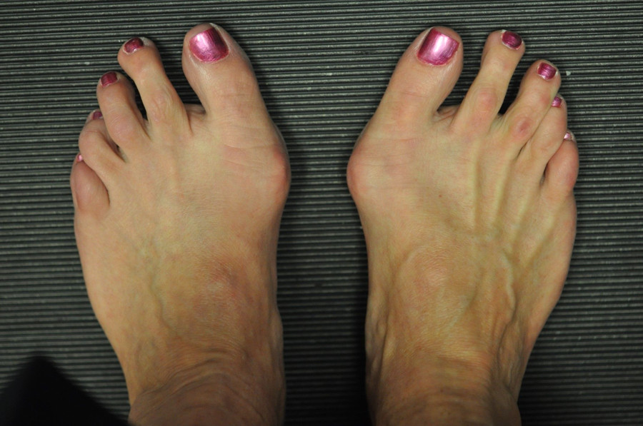 Bunions
