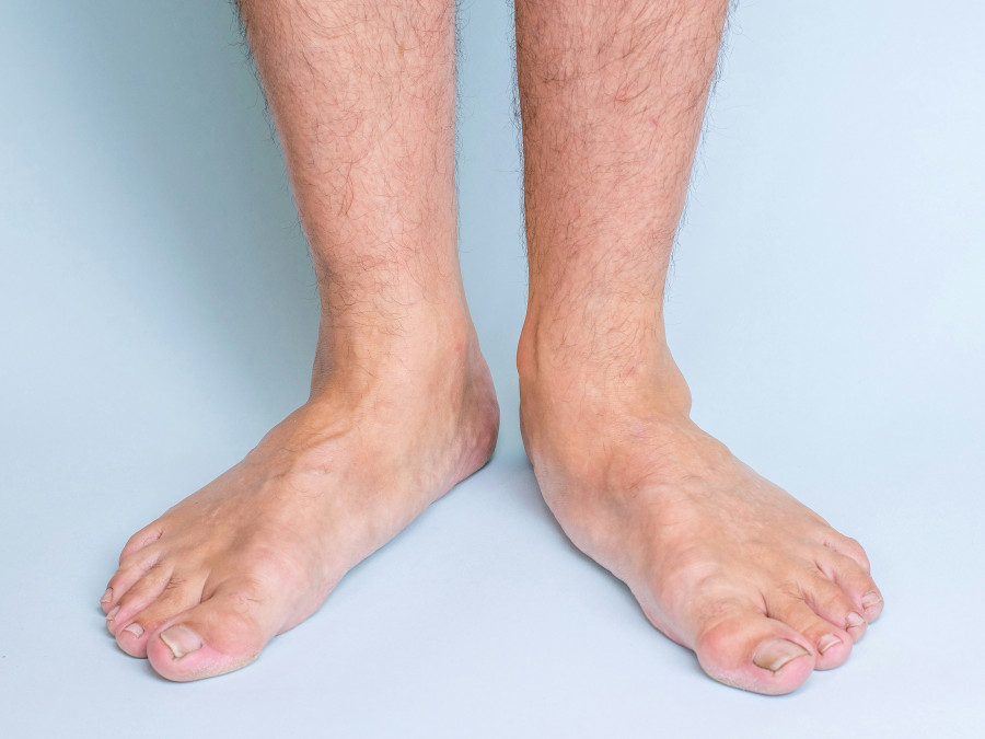 Flat feet / fallen arches