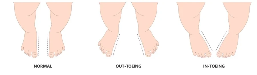 Normal vs out-toeing vs in-toeing