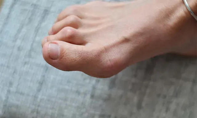 Crinkled toes / hammertoes