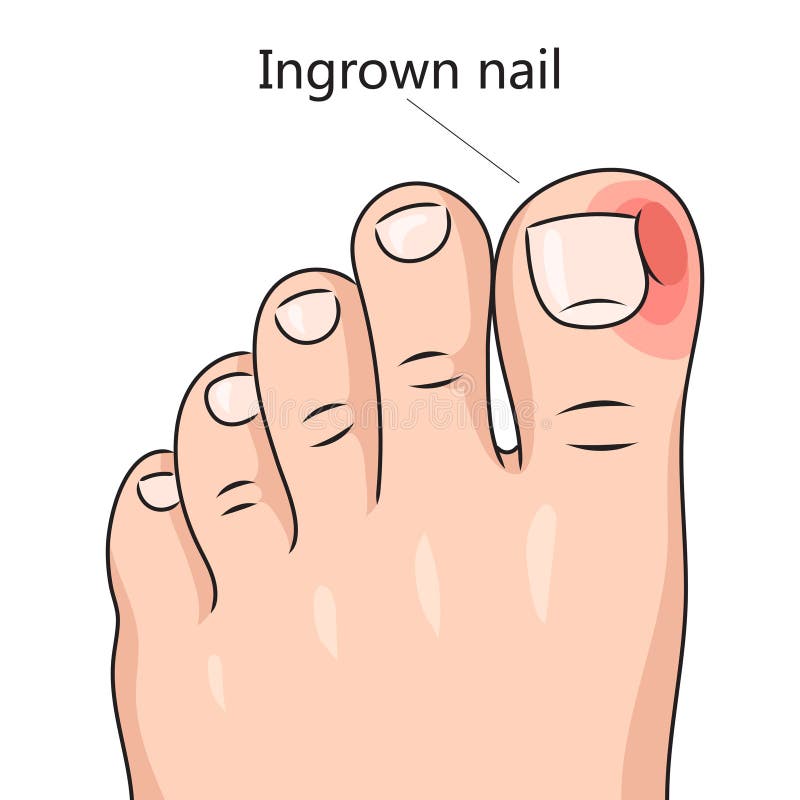 Chronically ingrown toenails