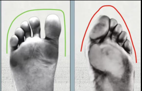 Wide vs squished/compressed toes